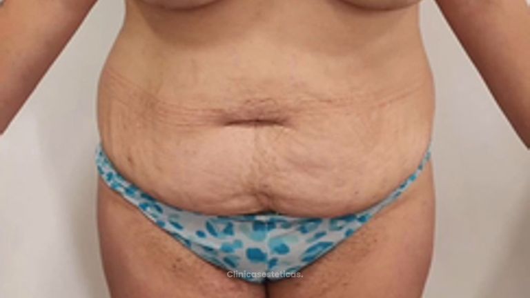 Abdominoplastia - Dr. Nadir Carda