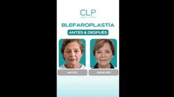 Blefaroplastía - Dr. Pedro Vidal G-H