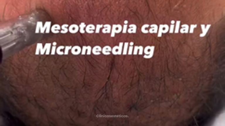Mesoterapia - Clínica Berríos