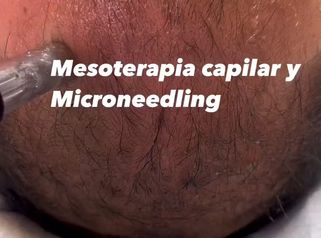 Mesoterapia - Clínica Berríos