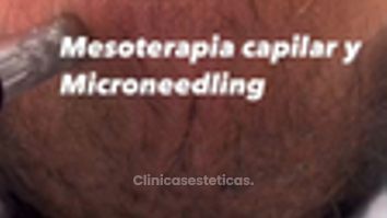 Mesoterapia - Clínica Berríos