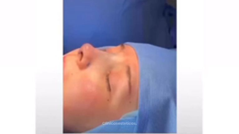 Rinoplastia - Dr Christian Salem Zamorano