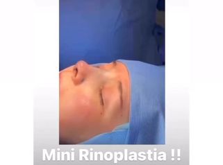 Rinoplastia - Dr Christian Salem Zamorano