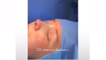 Rinoplastia - Dr Christian Salem Zamorano