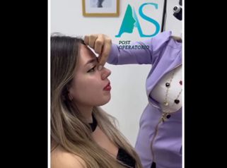 Rinoplastia - Dra. Angelica Sifontes Muñoz