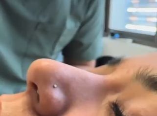 Perfiloplastia con acido hialurónico - Dr. Julio Vallejos