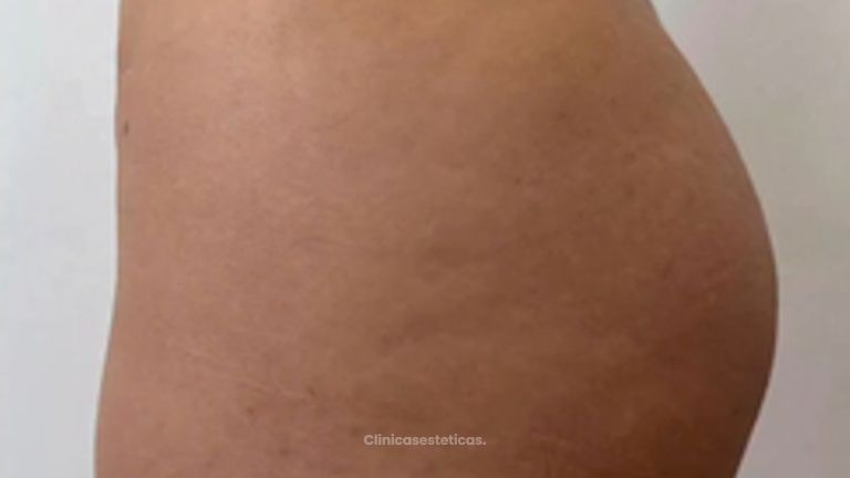 Aumento de Glúteos  - Dr. Guillermo Santana