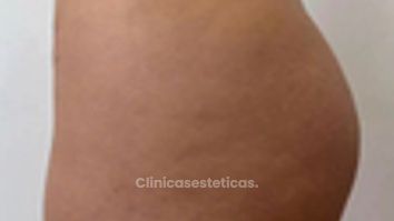 Aumento de Glúteos  - Dr. Guillermo Santana