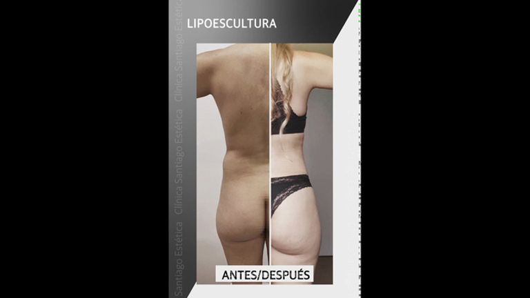 Lipoescultura - Clínica Santiago Estética