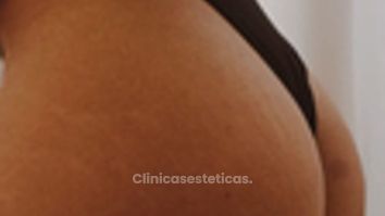 Aumento glúteos - Dr. Nadir Carda