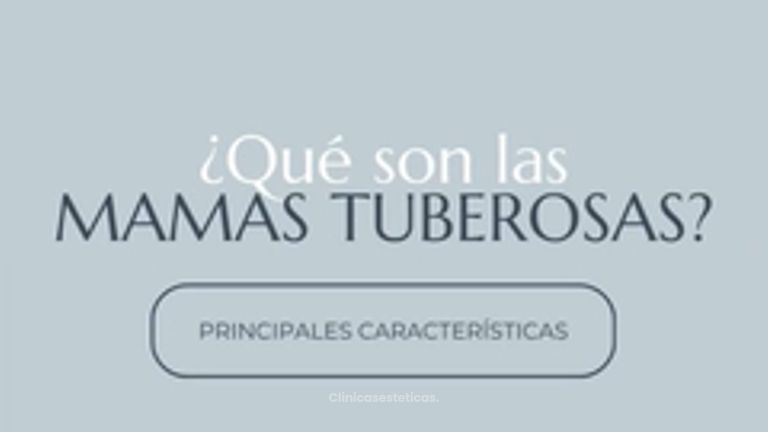 Mamas tuberosas - Dr. Nadir Carda