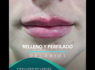 Relleno y Perfilado de Labios - Viveclinic