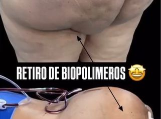 Retiro de Biopolímeros - Dr. Guillermo Santana