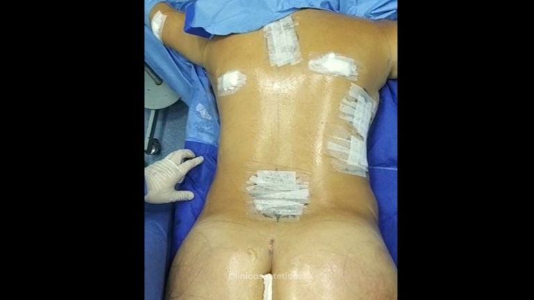 Lipo Clinic By Dr Puchi Clínica De Lipoescultura Hd