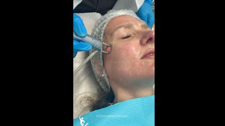 3 sesiones Limpieza Facial Aquapure – Clinica Kinelawen