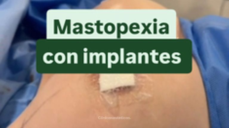 Mastopexia con implantes - Cirugía Plástica Dieppa