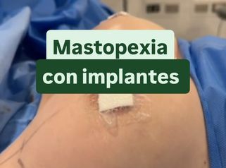 Mastopexia con implantes - Cirugía Plástica Dieppa
