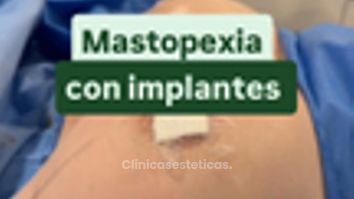 Mastopexia con implantes - Cirugía Plástica Dieppa