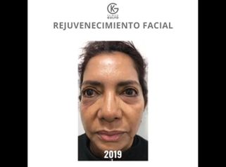 Rejuvenecimiento facial - Dra. Kelly Gulfo