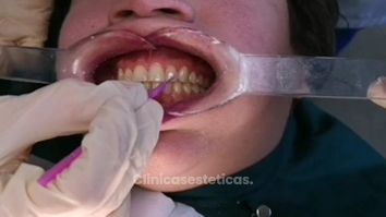 Tratamiento blanqueamiento dental