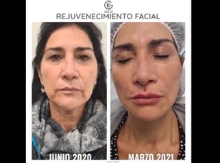 Rejuvenecimiento facial - Dra. Kelly Gulfo