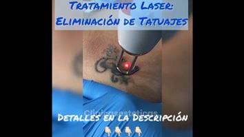 Borrar tatuajes