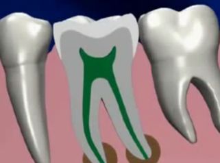 Lo que debes saber sobre la endodoncia