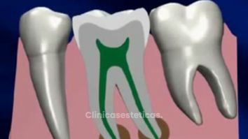 Lo que debes saber sobre la endodoncia