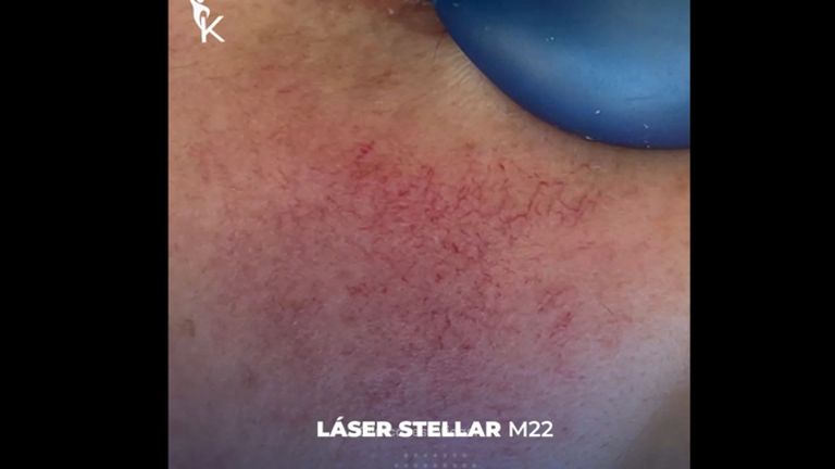 Láser CO2 Stellar - Kinelawen