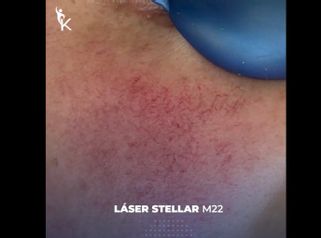 Láser CO2 Stellar - Kinelawen