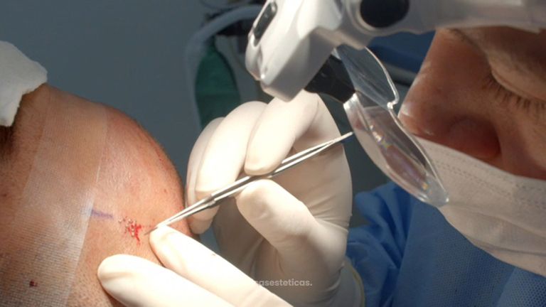Tratamiento para Hombres - Implante Capilar