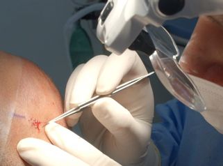 Tratamiento para Hombres - Implante Capilar