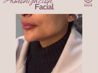 Armonización Facial - Clinica Dra. Kelly Gulfo