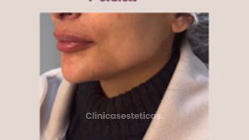 Armonización Facial - Clinica Dra. Kelly Gulfo