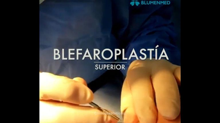 Blefaroplastia - Clínica Doctor Flores Aqueveque