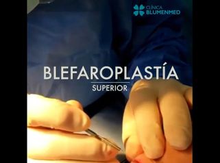 Blefaroplastia - Clínica Doctor Flores Aqueveque