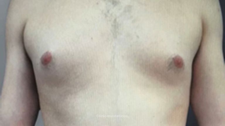 Lipo Vaser - Clinica Bendov