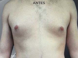 Lipo Vaser - Clinica Bendov