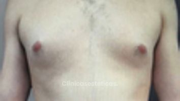 Lipo Vaser - Clinica Bendov