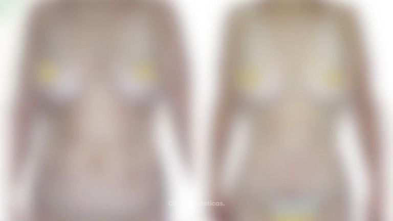 Abdominoplastia -Cirugía Plástica Dieppa