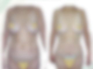 Abdominoplastia -Cirugía Plástica Dieppa