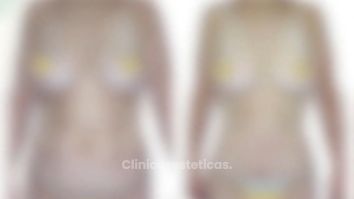 Abdominoplastia -Cirugía Plástica Dieppa