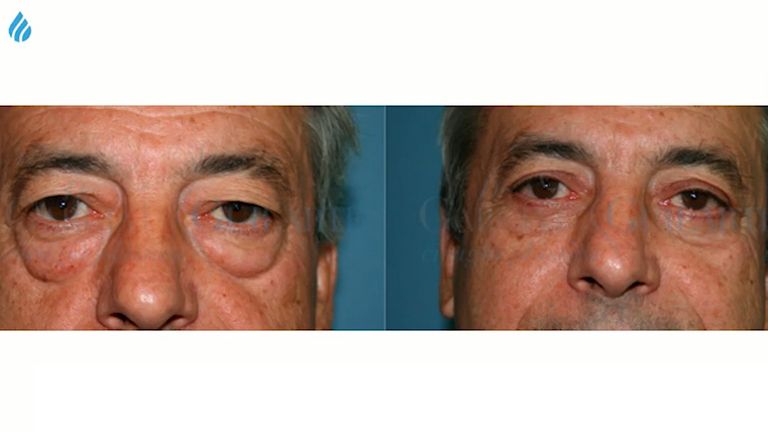 Algunas explicaciones sobre el tratamiento de Blefaroplastìa