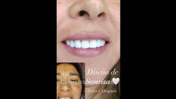 Blanqueamiento dental - Dra. Katherin Ruiz Márquez