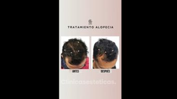 Alopecia - Clínica Dra. Kelly Gulfo