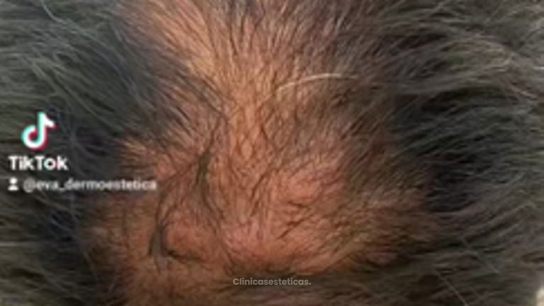 Alopecia - Eva Dermoestética