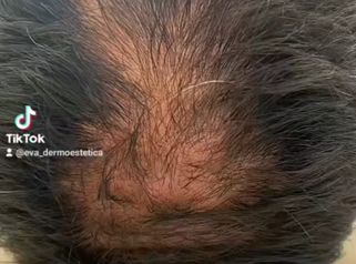 Alopecia - Eva Dermoestética