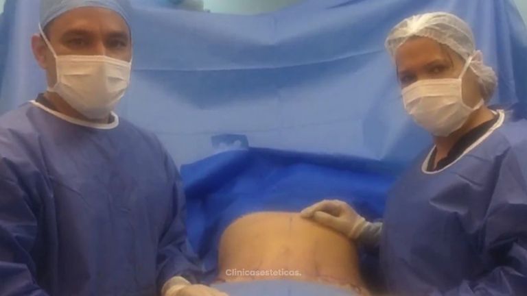Abdominoplastia 