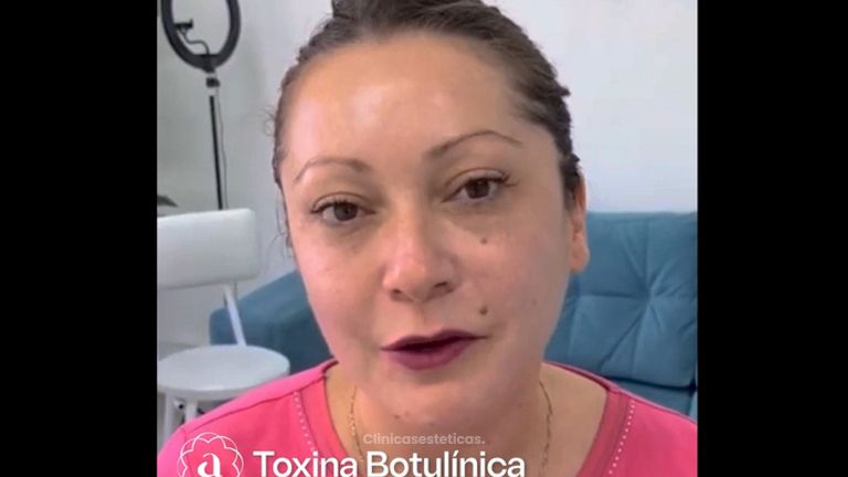 Toxina Botulínica - Amanda Beauty