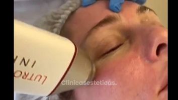 Tratamiento  Infini de Lutronic 